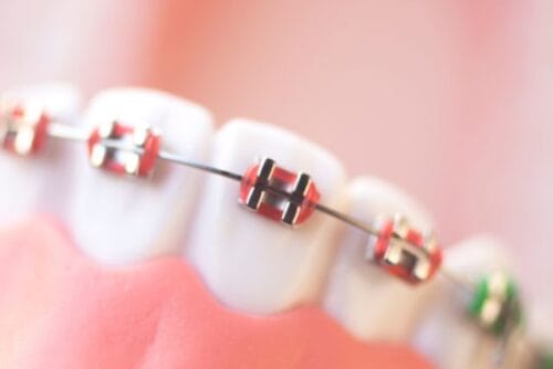 brackets autoligados esteticos