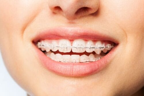 brackets autoligables ceramicos